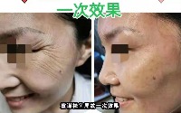 童谋去眼角纹、川字纹